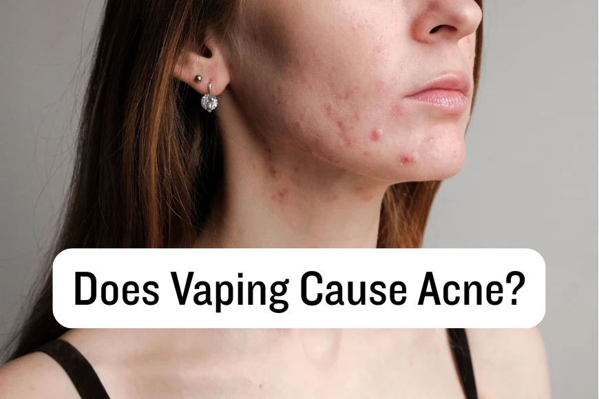 does vaping cause acne